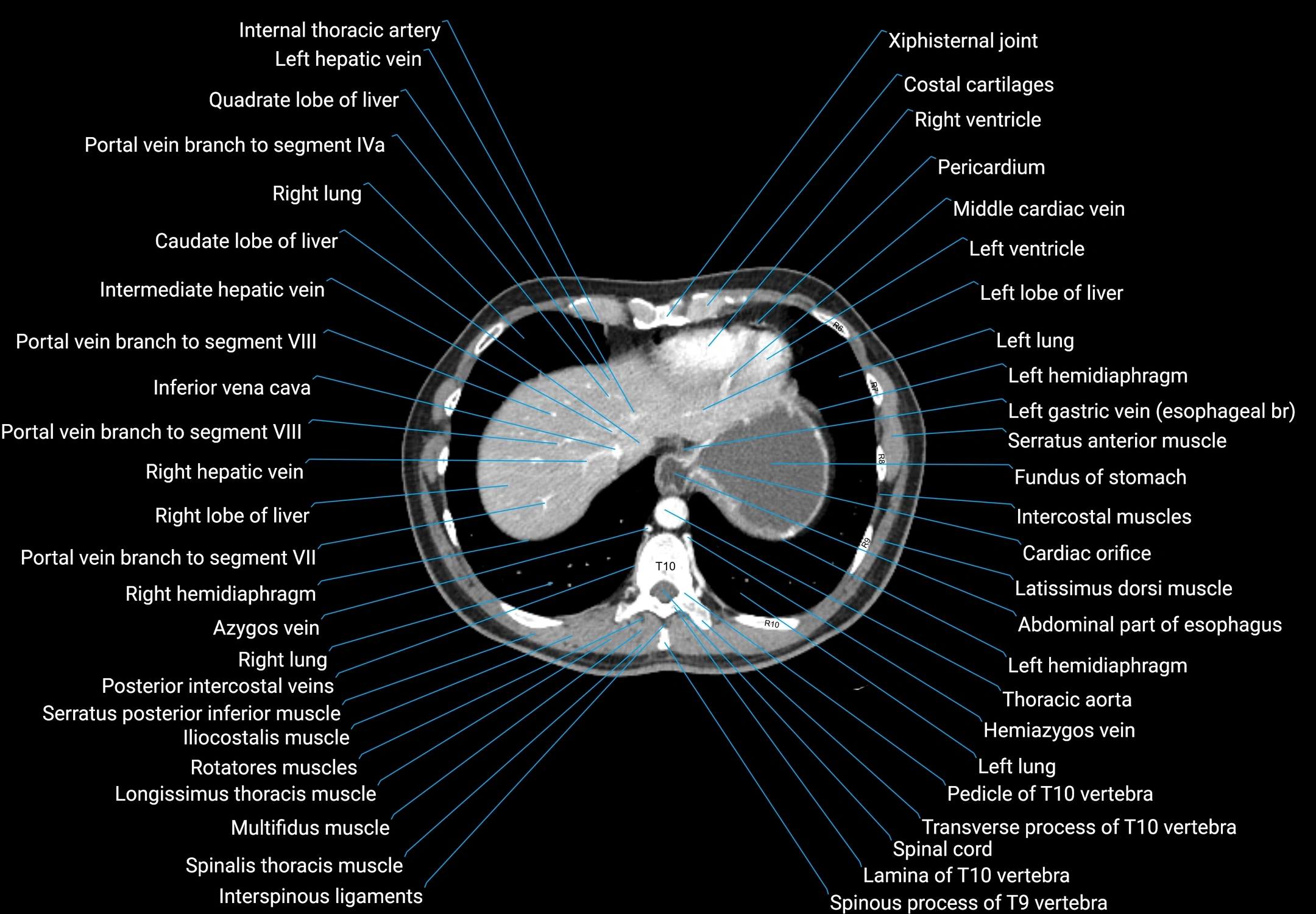 CT male pelvis axial cross sectional anatomy labelled radiology image -00015.webp